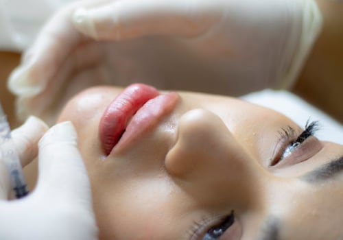 Framed In Style: Lip Fillers In Chicago To Complement Your New Hairstyle