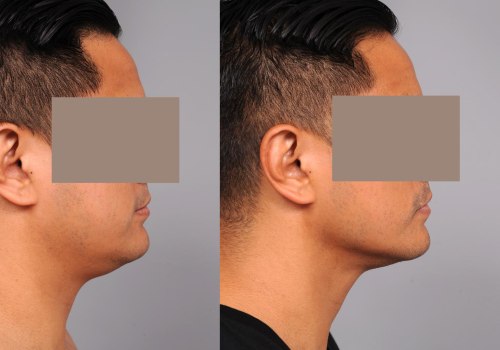 Say Goodbye To Neck Fullness For Better Hairstyling: Neck Liposuction NYC