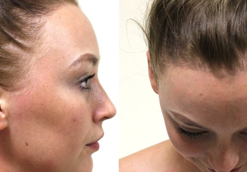 Can hairstyle cause hair loss?